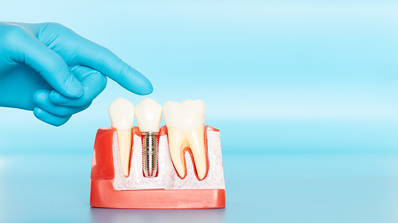 Cadillac MI dental implant dentists