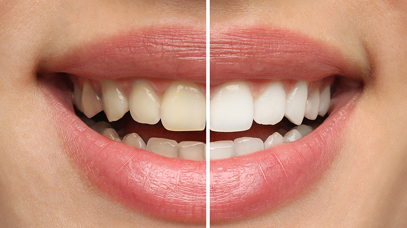 Professional teeth whitening Cadillac MI cosmetic dentists